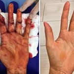 Αυτό είναι το χέρι γνωστής αθλήτριας μετά την επίθεση με μαχαίρι που δέχτηκε!