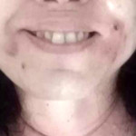 Παράνομα Botox Υαλουρονικά: Παραμορφώθηκα Λέει Θύμα Στο Star