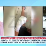 Θεσσαλονίκη: 17χρονος Έχασε 4 Δάχτυλα Σε Εργατικό Ατύχημα