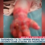 Βόλος: Μεταμόσχευση Θα Χρειαστεί Το Βρέφος Με Το Έγκαυμα