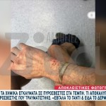 Τέμπη: Ντοκουμέντα Από Τα Χημικά Εγκαύματα Των Πυροσβεστών