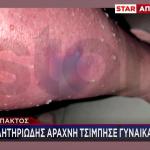 Ναύπακτος: Δηλητηριώδης Αράχνη Τσίμπησε Γυναίκα Στο Πόδι