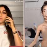 Συγκλονίζει Η Έλλη Που Νίκησε Την Ανορεξία - Ζύγιζα 31 Κιλά