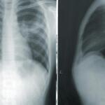 Μέθοδος Butt breathing