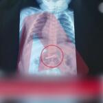 Τρίχρονο Παιδί Κατάπιε Ξυραφάκι