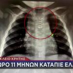 Ηράκλειο Κρήτης: Μωρό 11 Μηνών Κατάπιε Ελατήριο