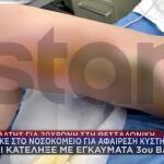Θεσσαλονίκη: Πήγε Για Κύστη Κόκκυγος- Κατέληξε Με Εγκαύματα