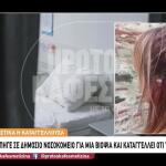 «Πήγα Για Βιοψία Και Έπαθα Χημικά Εγκαύματα Δευτέρου Βαθμού»