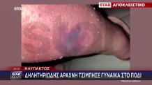 Ναύπακτος: Δηλητηριώδης Αράχνη Τσίμπησε Γυναίκα Στο Πόδι