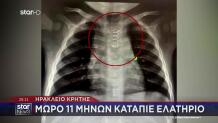 Ηράκλειο Κρήτης: Μωρό 11 Μηνών Κατάπιε Ελατήριο