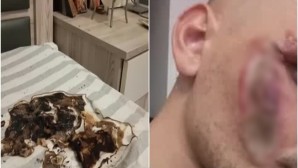 Κινητό Έσκασε Κατά Τη Διάρκεια Της Φόρτισης - Τραυματίσε Νέο