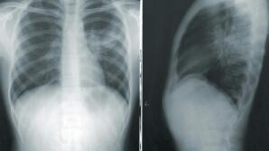 Μέθοδος Butt breathing