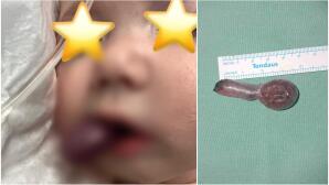 Κρήτη: Έσωσαν Μωρό 3 Μηνών Με Σπάνια Συγγενή Πάθηση Φάρυγγα