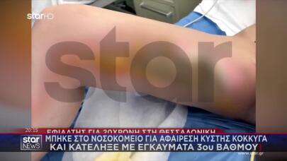 Θεσσαλονίκη: Πήγε Για Κύστη Κόκκυγος- Κατέληξε Με Εγκαύματα