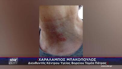 Πάτρα: Γυναίκα Ισχυρίζεται Ότι Τη Δάγκωσε Λαγοκέφαλος