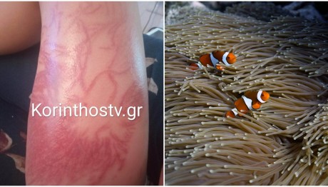 Θαλάσσια Ανεμώνη Τσίμπησε 9χρονο