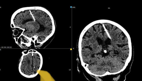Ρωσία: Ζούσε Με Μια Βελόνα Σφηνωμένη Στον Εγκέφαλό Της