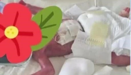 Πάτρα: Βγήκε Νικητής Πρόωρο Μωράκι - Είχε Γεννηθεί 600 gr.