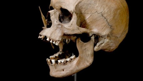 Αρχαίο DNA Εξηγεί Τα Υψηλά Ποσοστά Σκλύρηνσης Κατά Πλάκας