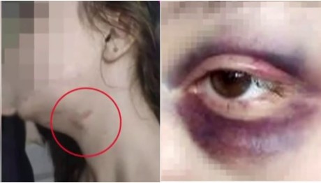 28χρονη Θύμα Ξυλοιδαρμού Από Τον Σύντροφό Της