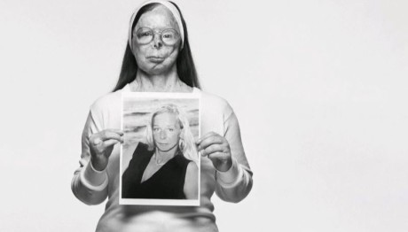 Επίθεση με οξύ: H συγκλονιστική ιστορία της Patricia Lefranc