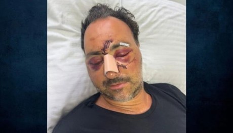 Ξυλοδαρμός Κρήτη: Προβλήματα Στην Όραση Για Τον Ελληνοκαναδό