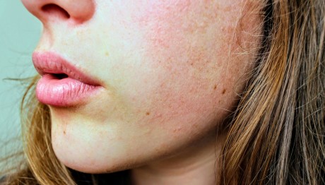 ερυθρότητα δέρματος