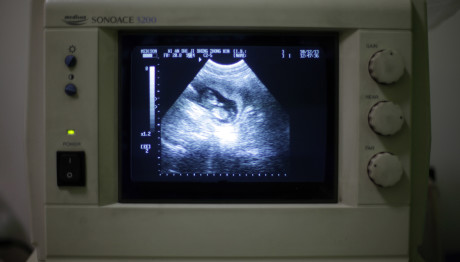 Κίνα: Γυναίκα Με Δύο Μήτρες Γέννησε Δίδυμα