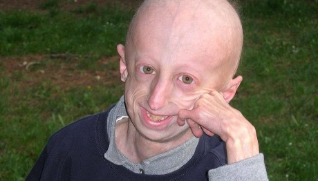 Πέθανε Ο Ασθενής Που Έζησε Περισσότερο Με Προγηρία