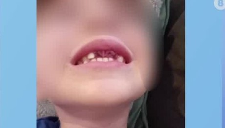 Ξυλοδαρμός 4χρονου: Το Σχολείο Έλεγε Ότι Σκόνταψε