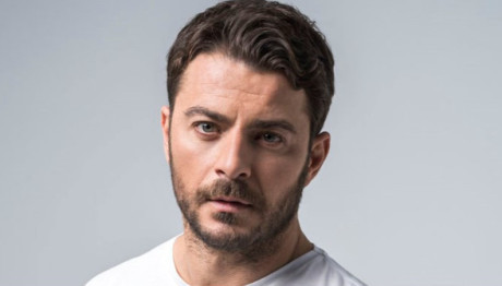 Γιώργος Αγγελόπουλος: Έκανε Εμφύτευση Μαλλιών