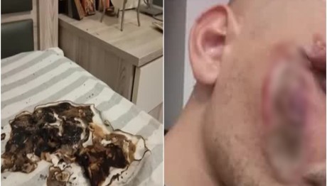 Κινητό Έσκασε Κατά Τη Διάρκεια Της Φόρτισης - Τραυματίσε Νέο