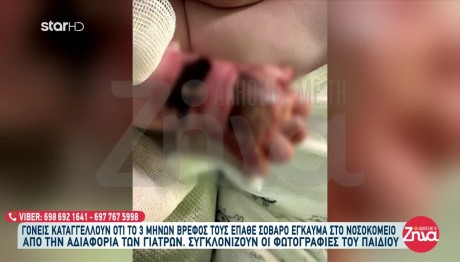 Βρέφος 3 Μηνών Έπαθε Έγκαυμα Στο Χέρι Από Ορό Σε Νοσοκομείο!