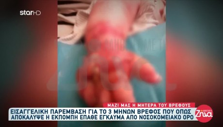 Βόλος: Μεταμόσχευση Θα Χρειαστεί Το Βρέφος Με Το Έγκαυμα