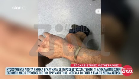 Τέμπη: Ντοκουμέντα Από Τα Χημικά Εγκαύματα Των Πυροσβεστών