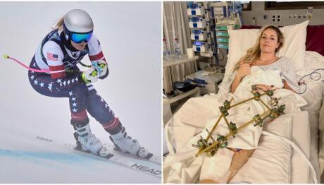 Λίντσεϊ Βον: «Μπορεί Ακόμα Και Να Ακρωτηριαστεί Το Πόδι Της»