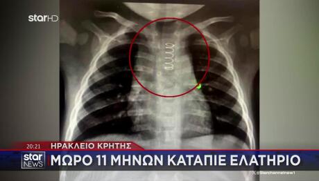 Ηράκλειο Κρήτης: Μωρό 11 Μηνών Κατάπιε Ελατήριο