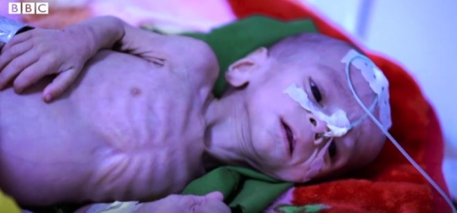 Αφγανιστάν μωρό πείνα