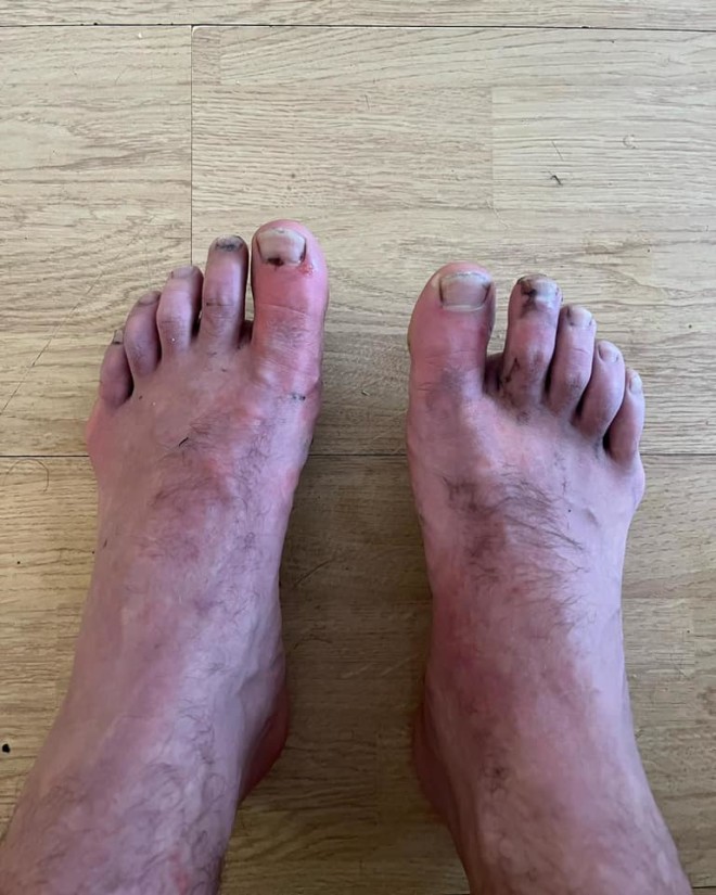 Τα πόδια του κ. Γιαννάκου γεμάτα πληγές από τα πολλά χλμ στο χιόνι και τον πάγο