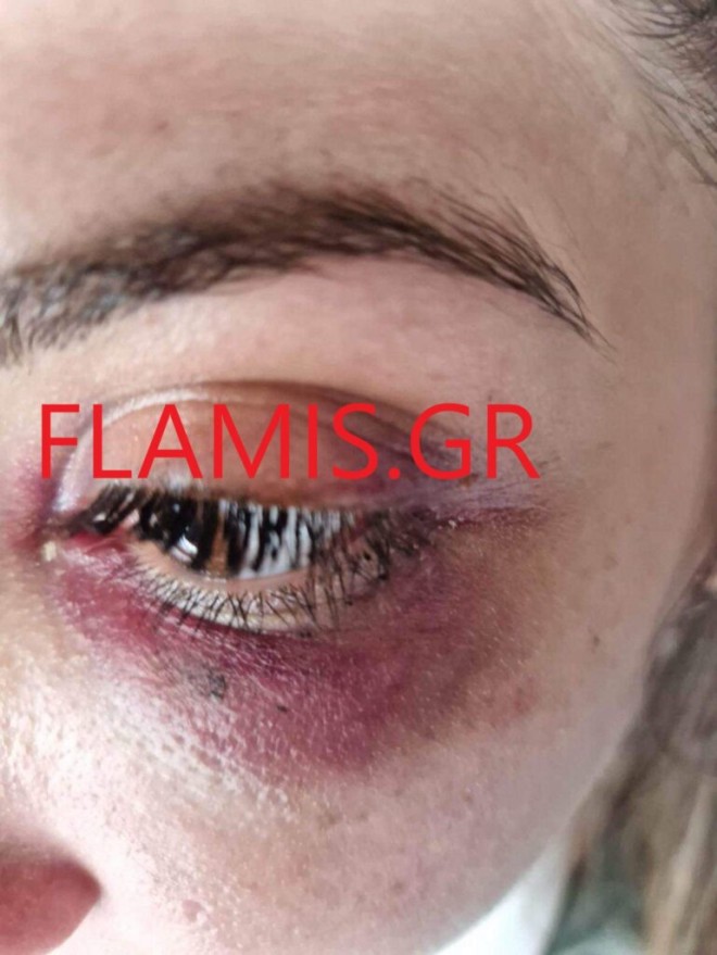 To μάτι της 31χρονης είναι μαυρισμένο από τις γροθιές του συντρόφου της/ πηγή flamis.gr