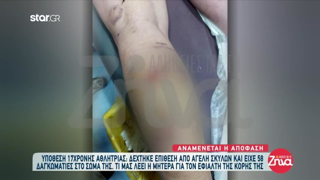Άγρια επίθεση από αγέλη σκύλων είχε δεχτεί μία 17χρονη μαθήτρια και αθλήτρια kick-boxing στη Θεσσαλονίκη 