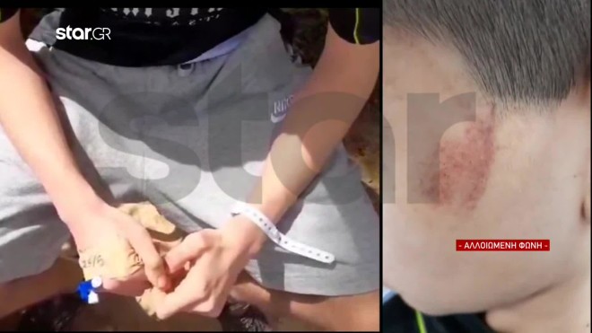 Τα σημάδια από τα άγρια χτυπήματα στο πρόσωπο του 14χρονου- κεντρικό δελτίο ειδήσεων του Star
