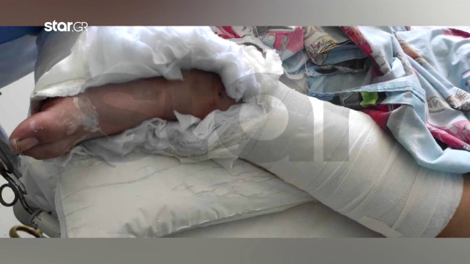 Θεσσαλονίκη: Σε χειρουργείο υπεβλήθη ο 13χρονος που παρασύρθηκε από οδηγό