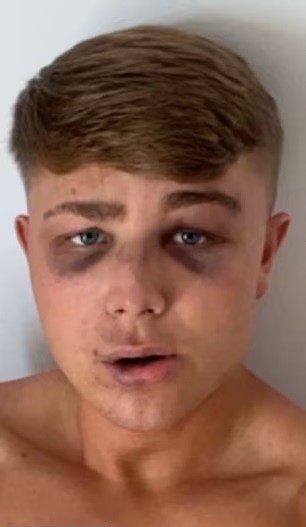 Με σημάδια από τα χτυπήματα που δέχθηκε από μπράβους στον Λαγανά Ζακύνθου είναι ο 18χρονος Βρετανός τουρίστας