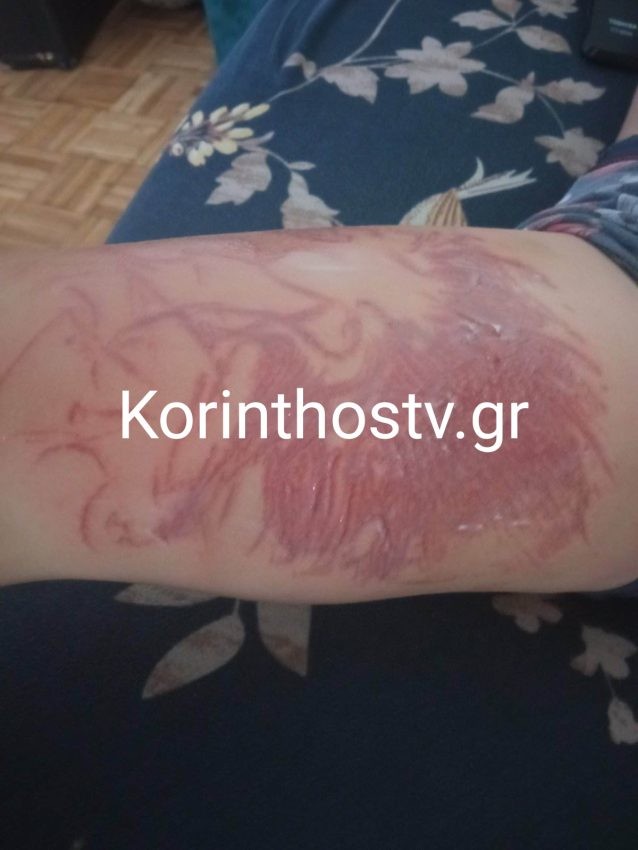 9χρονος τσιμπήθηκε από θαλάσσια ανεμώνη στην Κόρινθο - korinthos.tv