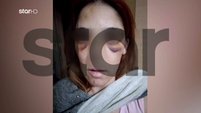 Άργος: Θύμα ενδοοικογενειακής βίας στο Star