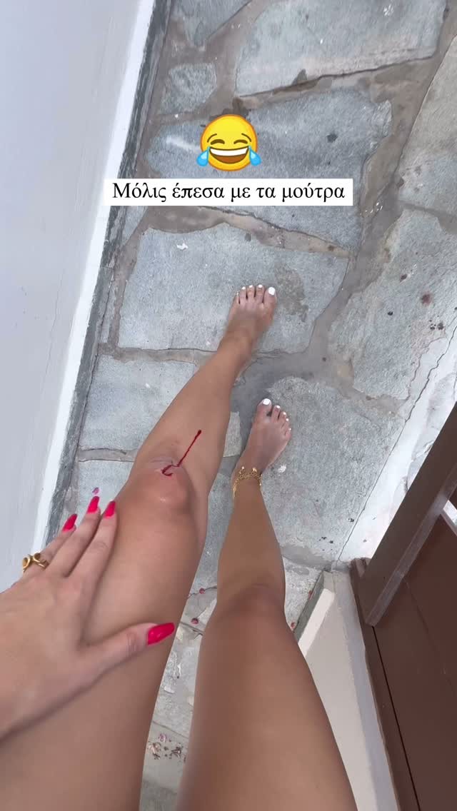 Το ατύχημα της Ιωάννας Τούνη στη Σύρο- «Μόλις έπεσα με τα μούτρα»