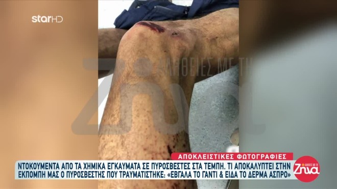 Τέμπη: Ντοκουμέντα από τα χημικά εγκαύματα των πυροσβεστών