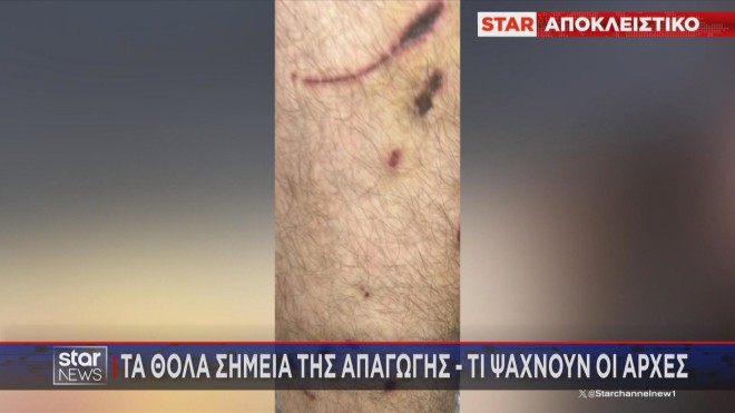 Τα σημάδια από τις πληγές από τα χτυπήματα με κατσαβίδι στο θύμα της απαγωγής 