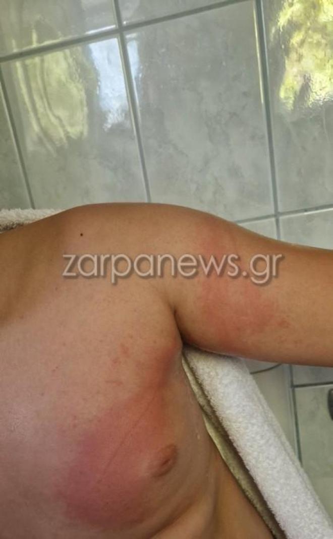Θαλάσσια ανεμώνη τσίμπησε παιδί στην Κρήτη